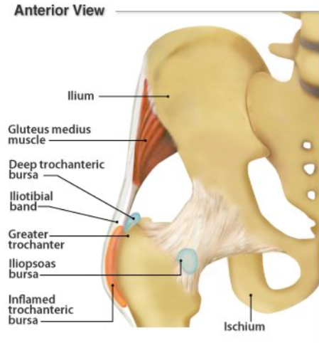 What is Greater Trochanteric Pain Syndrome (GTPS)?