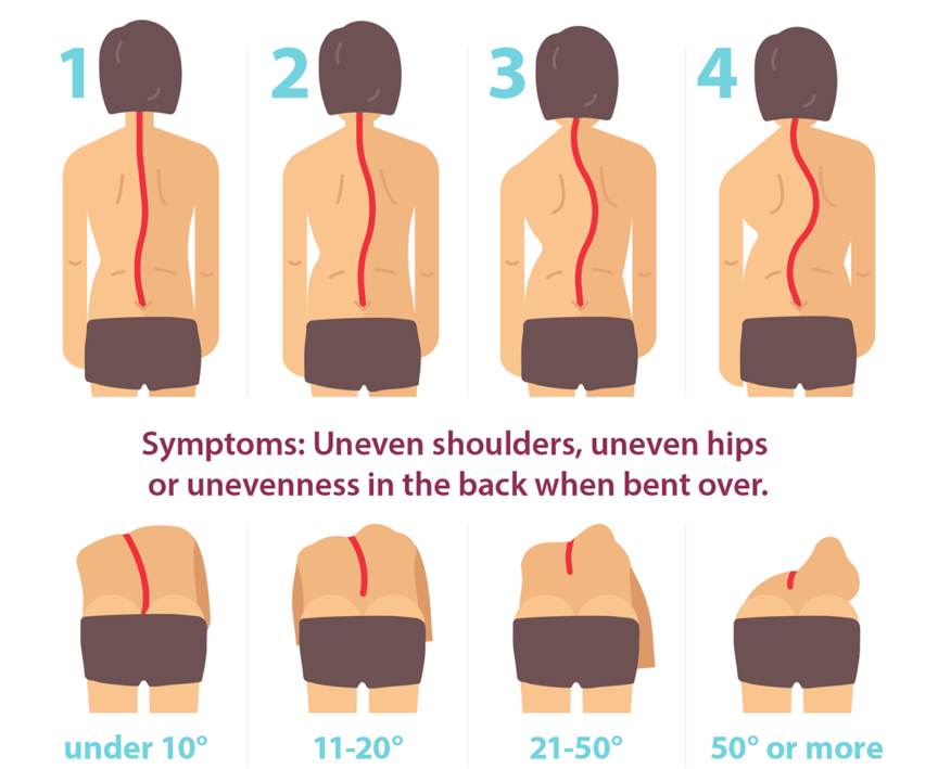 waist training scoliosis