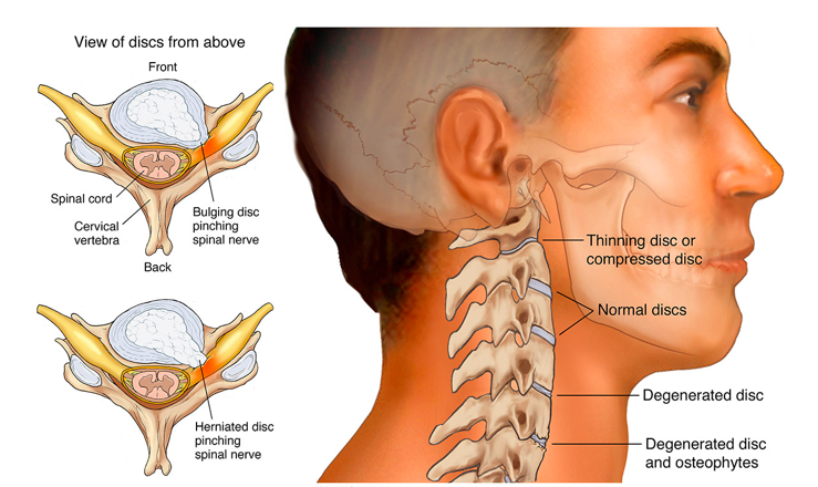 Cervical spine disc bulge